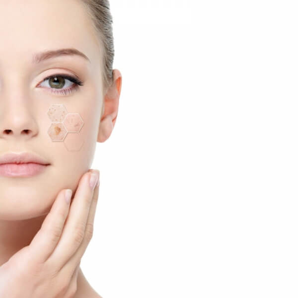 FACIAL LASER IPL ( ACNÉ MANCHAS ROSÁCEA )