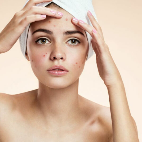 Tratamiento ACNE (LEVE o MODERADO) FASE 1