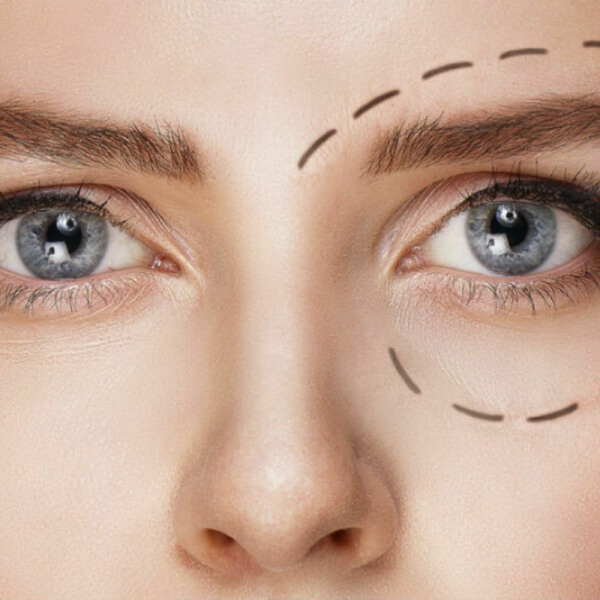 Tratamiento Ojeras