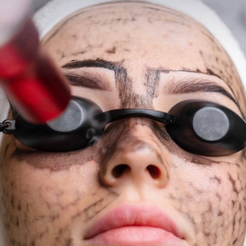 2X1 FACIAL LASER PEEL