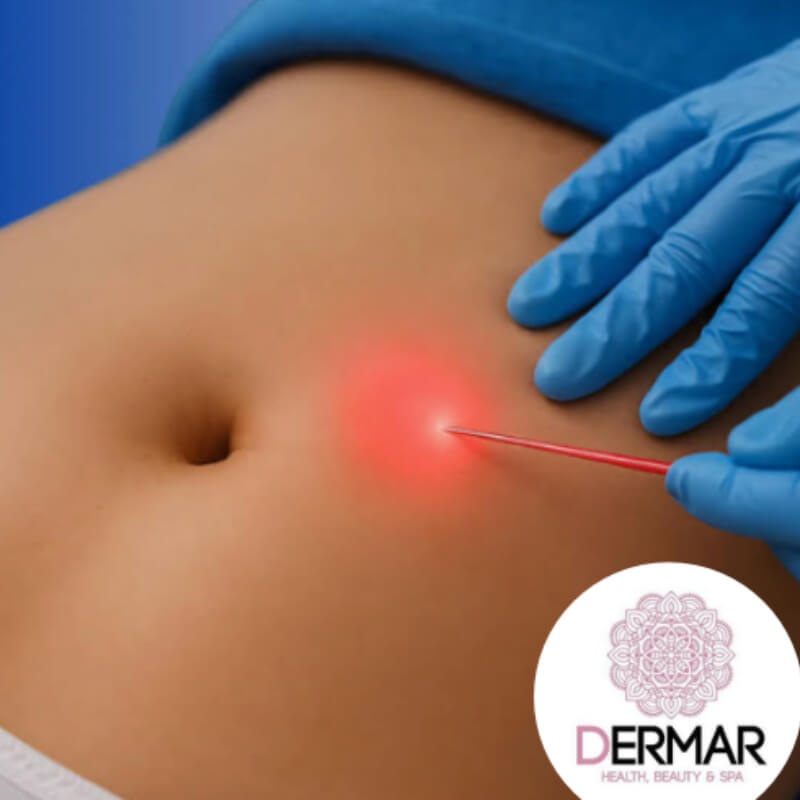 Endolyse Abdominal