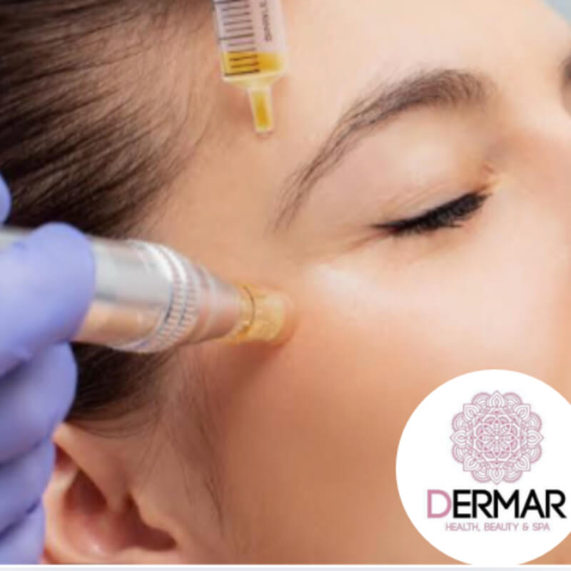 Redensificacion facial