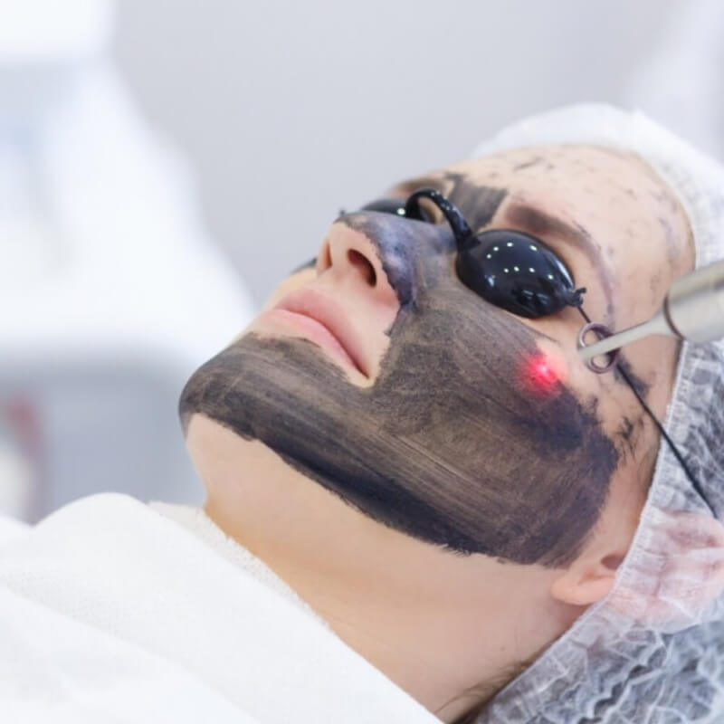 SESION CARBON PEEL AXILA